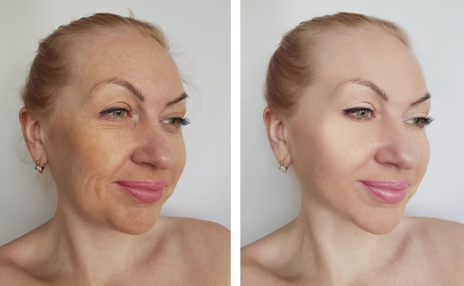 dr-krushel-sculptra-252111630_XL-2000px-85p